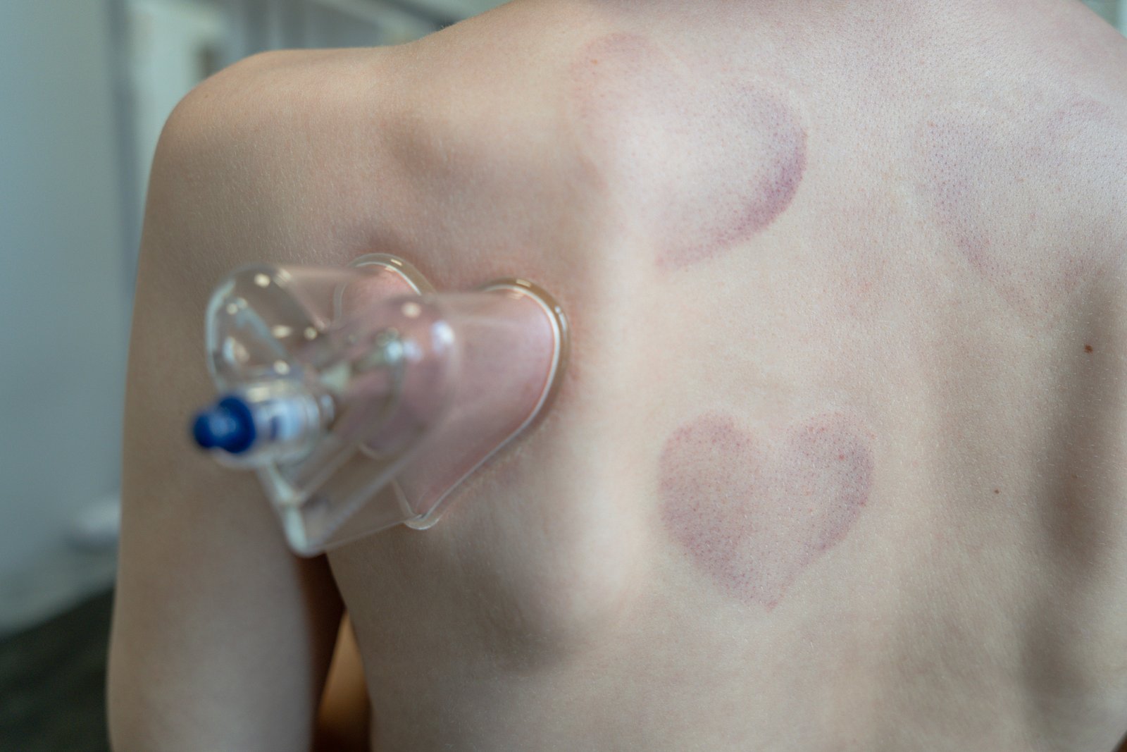 Terapia Cupping